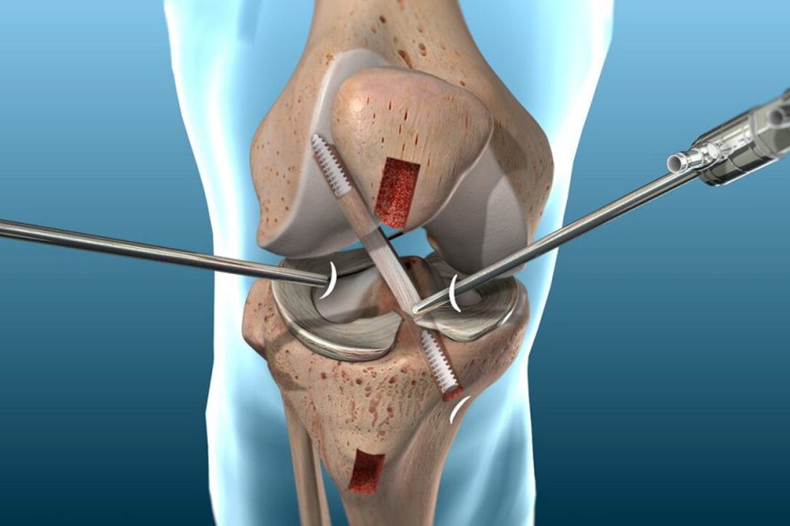 ACL-PCL-Meniscus-Surgery