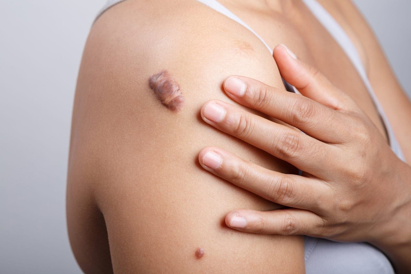 Keloid-&-Scar-Treatment