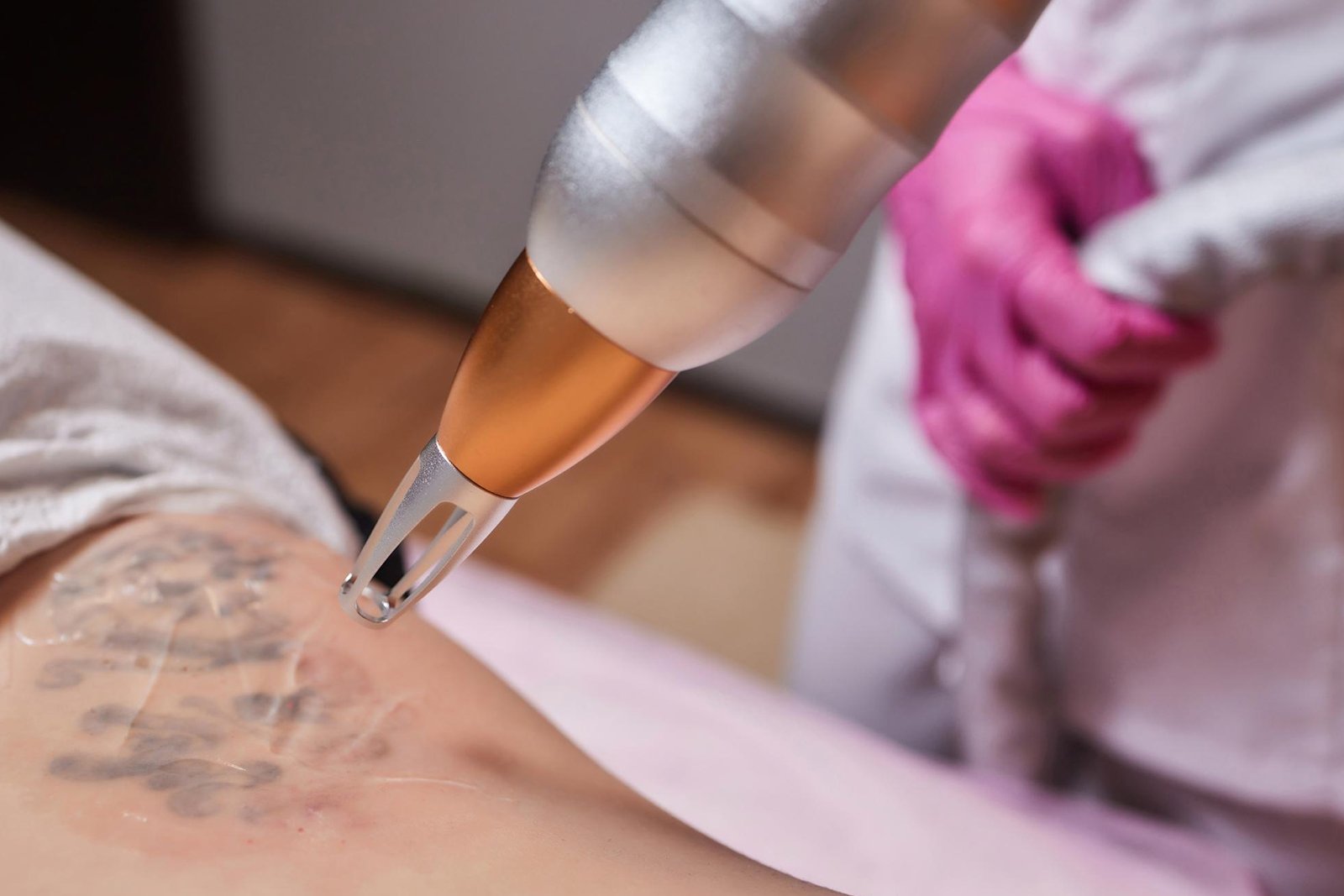 Laser-Tattoo-Birthmark-Freckles-Removal