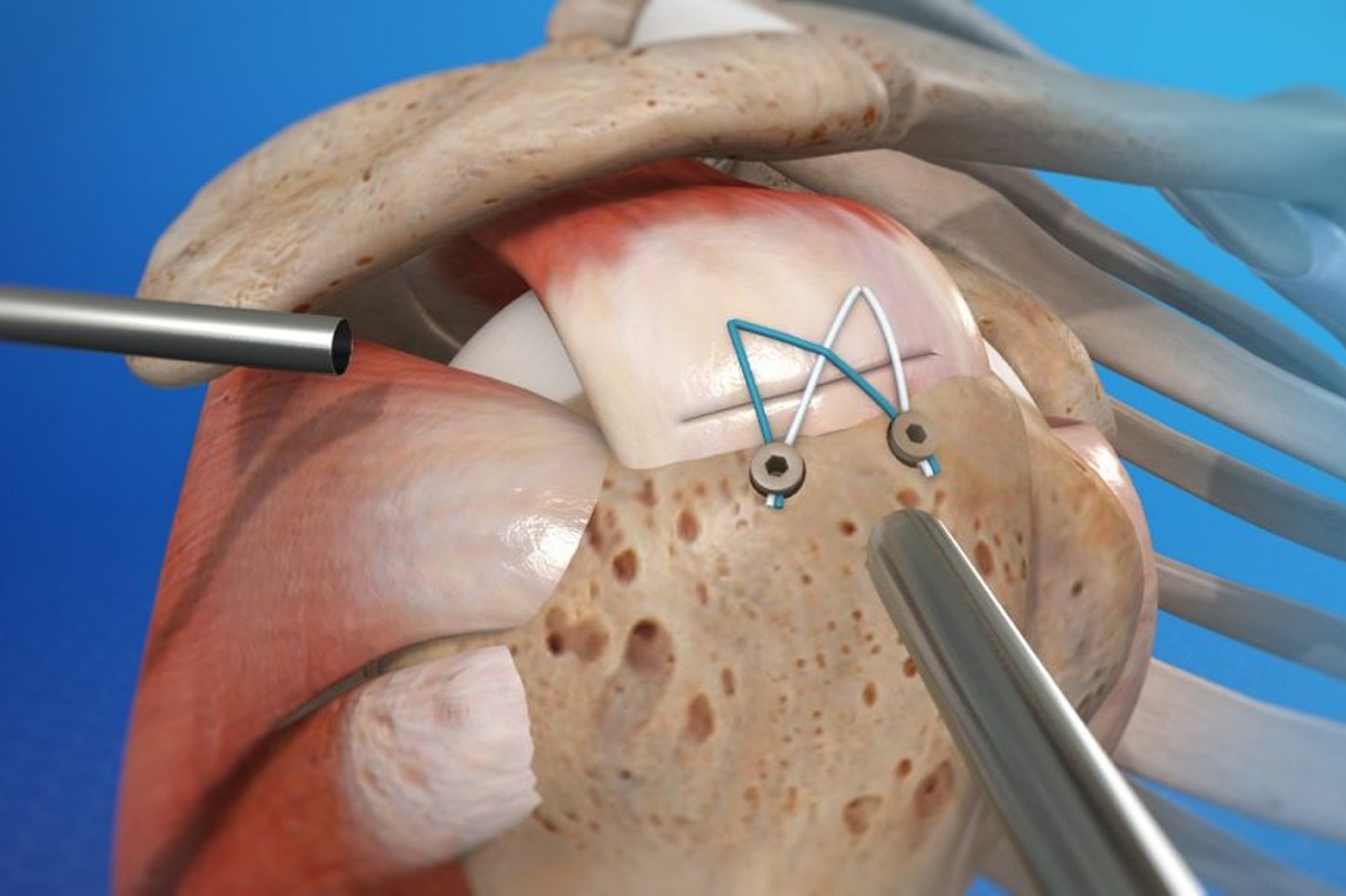 Rotator-Cuff-Repair-Bankart-Repair