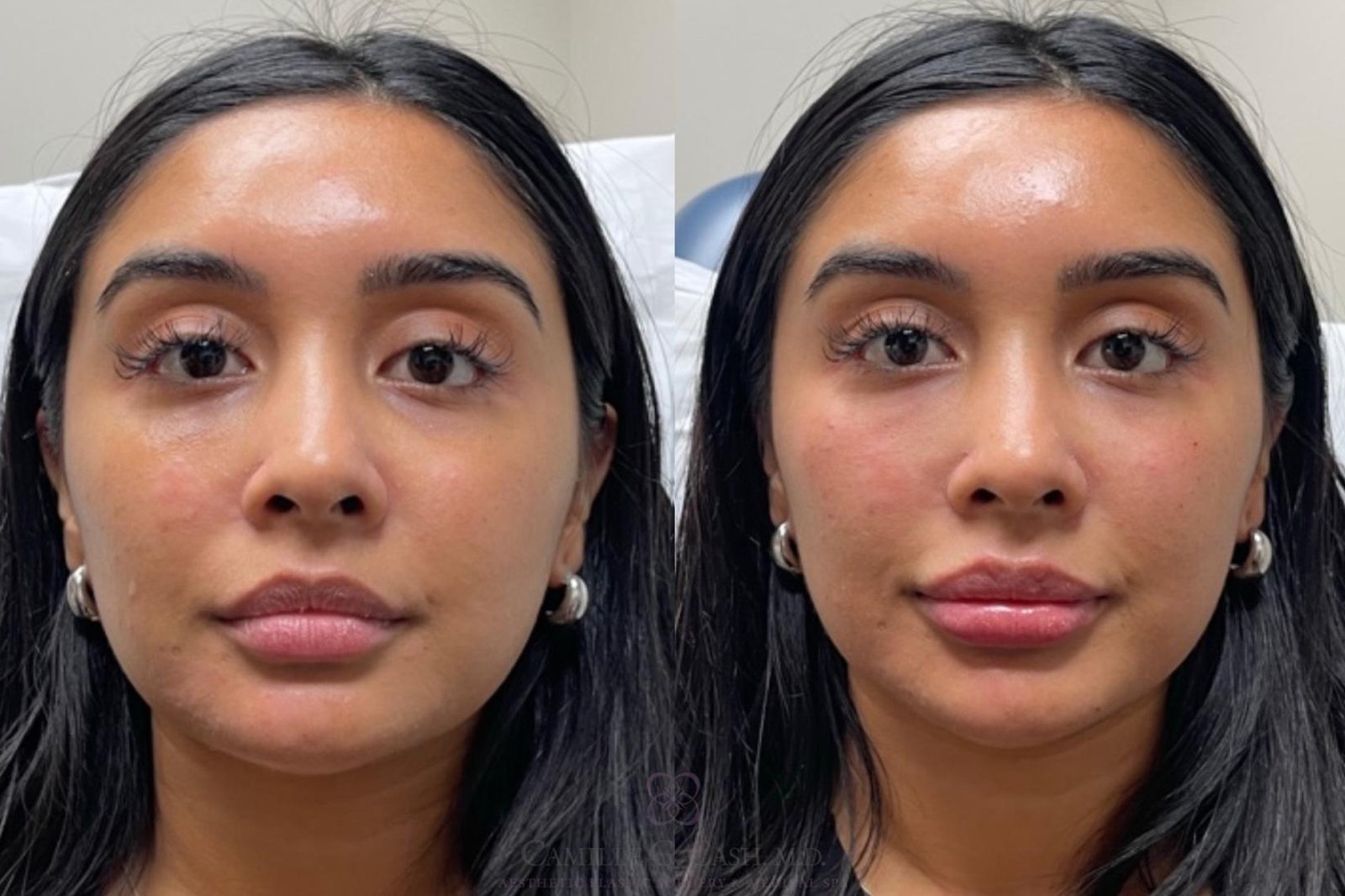 skin-Fillers