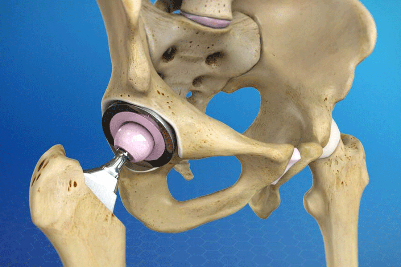 Total-Hip-Replacement