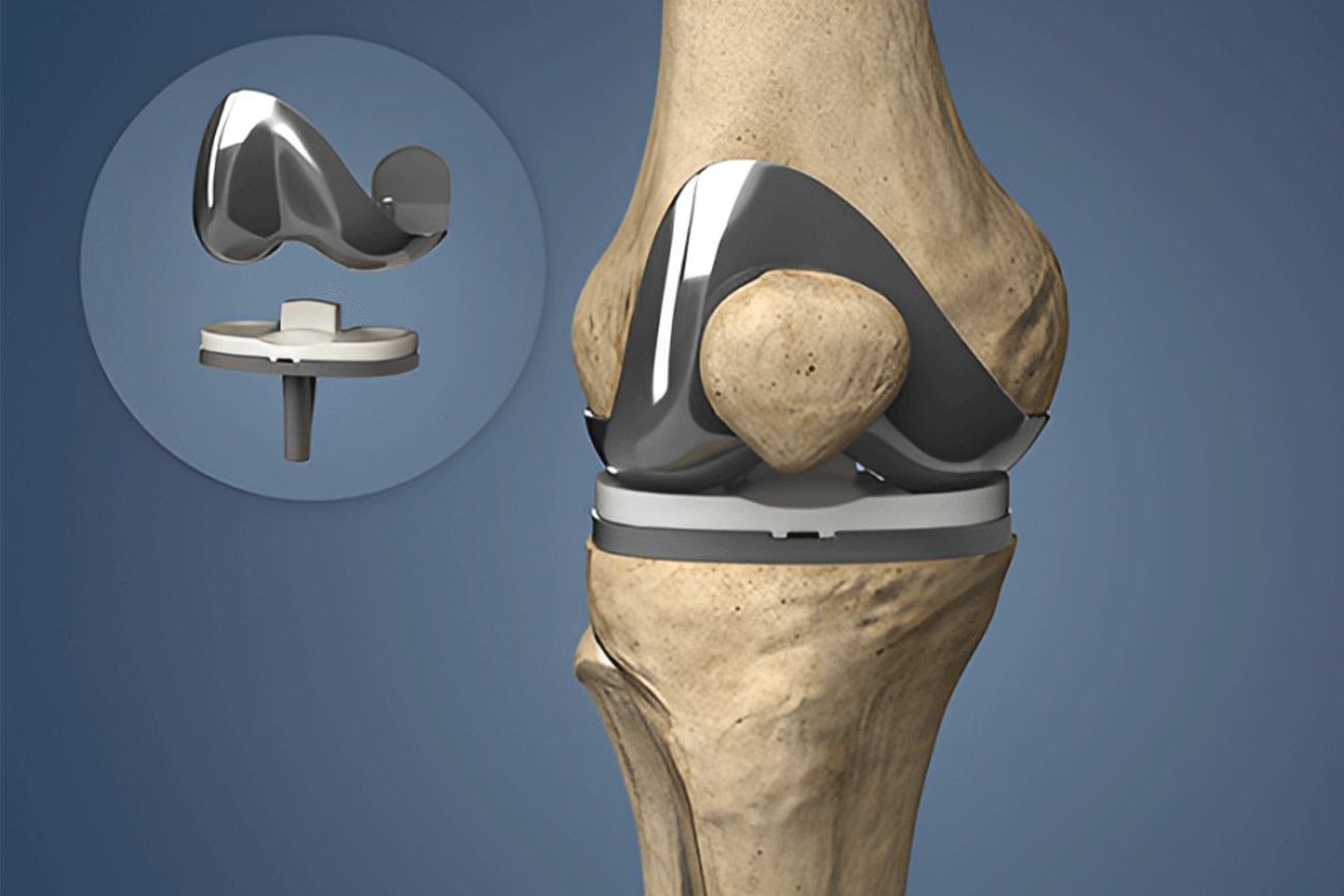 total-knee-replacement